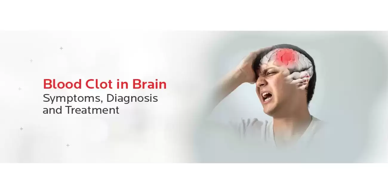 Blood Clot In Brain Understanding Symptoms Diagnosis Treatment RBH